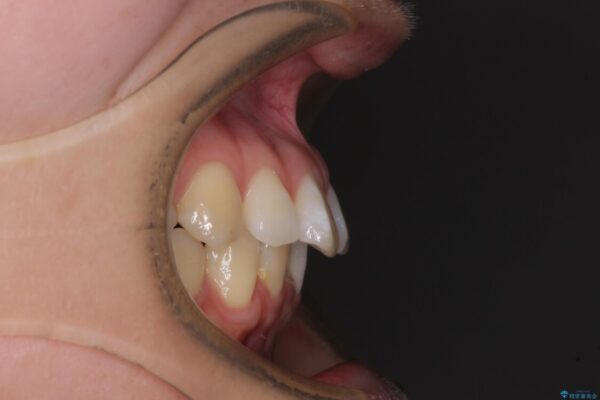 【モニター】すきっ歯をインビザラインで解消 治療前画像