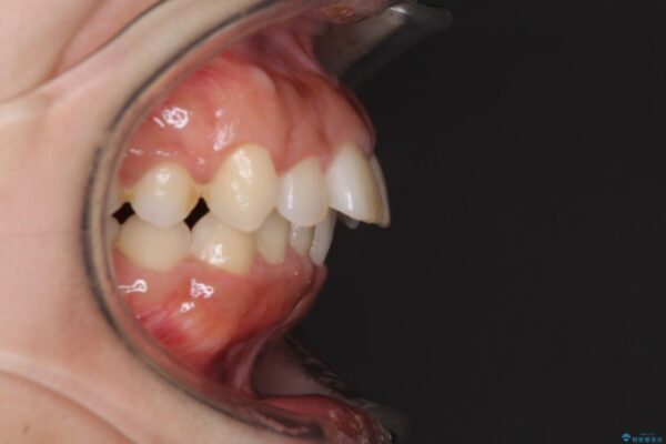 口がしっかりと閉じられない　ワイヤー装置での抜歯矯正で出っ歯を改善 治療前画像