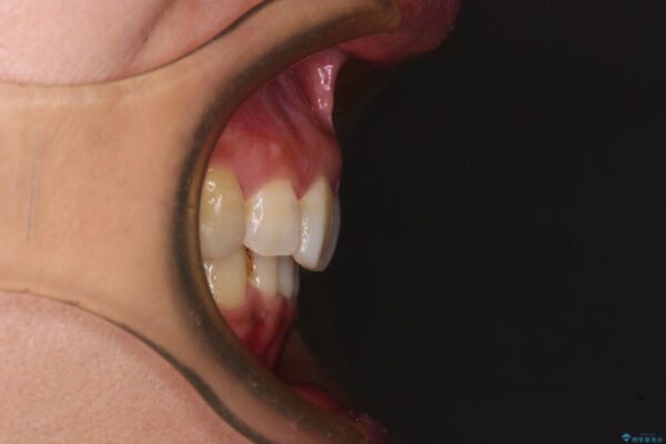 抜歯矯正の後戻りでできたスペース　インビザライン矯正とセラミック治療 治療後画像