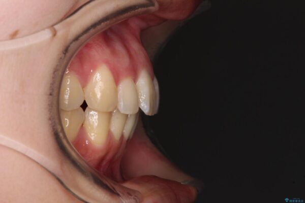 【モニター】飛び出した上顎前歯のワイヤー矯正で改善 治療後画像