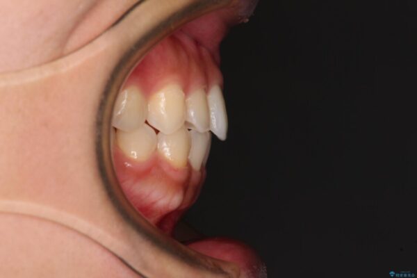 インビザラインを用いた上顎の部分矯正 治療後画像