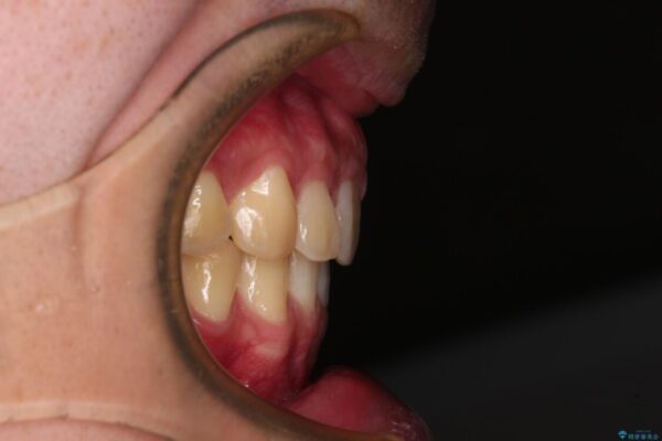強い咬み合わせで飛び出した前歯　インビザライン矯正で改善(ワイヤー装置併用) 治療後画像