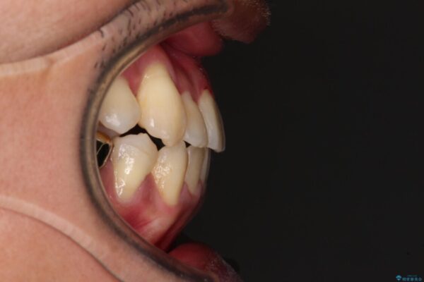 前歯のクロスバイトを改善　インビザライン矯正 治療後画像