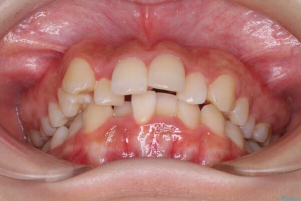 【モニター】八重歯とデコボコをスッキリきれいに　ワイヤー装置での抜歯矯正 治療前画像