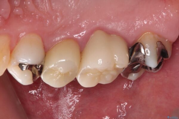 奥歯が痛い　セラミッククラウンでの虫歯治療 治療後画像