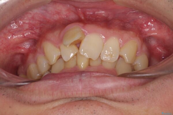前歯が折れたついでに歯並びも改善　矯正治療と前歯のセラミック治療 治療前画像