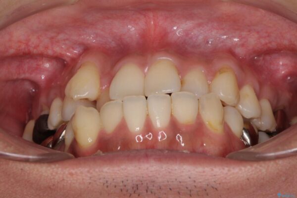 前歯のクロスバイトを改善　インビザライン矯正 治療前画像