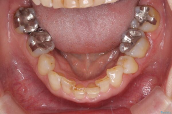抜歯が必要と言われた前歯　根管治療とオールセラミッククラウン 治療前画像