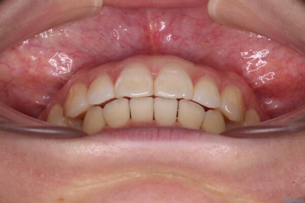 【モニター】すきっ歯をインビザラインで解消 治療途中画像