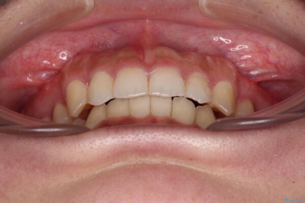著しい八重歯が気になる　インビザラインによる抜歯矯正治療(ワイヤー装置併用) 治療後画像