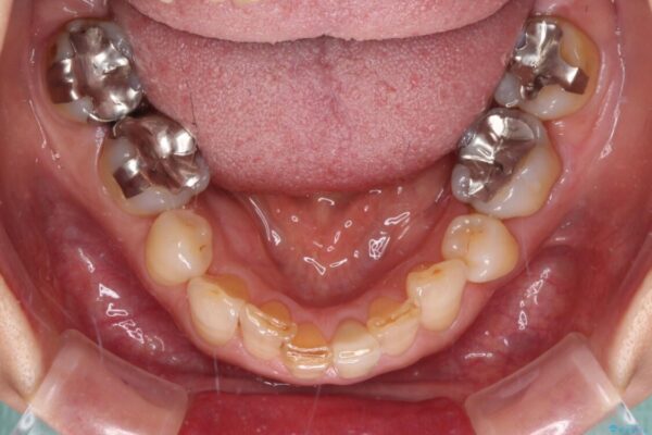 抜歯が必要と言われた前歯　根管治療とオールセラミッククラウン 治療後画像