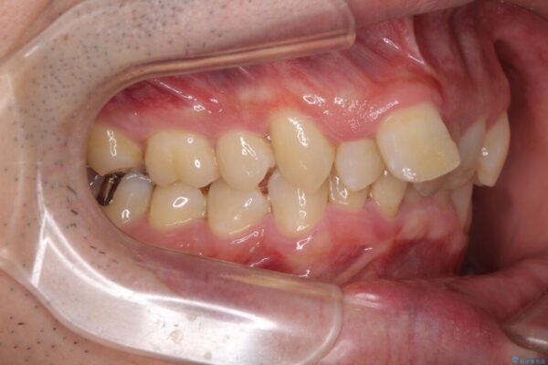 前歯が折れたついでに歯並びも改善　矯正治療と前歯のセラミック治療 治療前画像