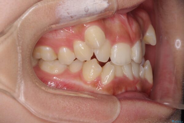 著しい八重歯が気になる　インビザラインによる抜歯矯正治療(ワイヤー装置併用) 治療前画像