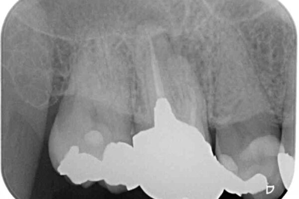 奥歯が痛い　セラミッククラウンでの虫歯治療 治療前画像