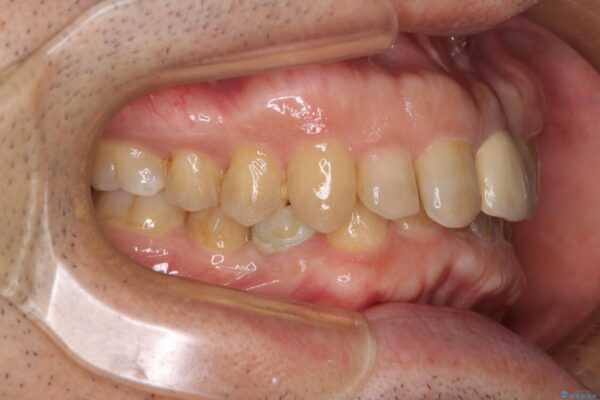 欠損歯列の矯正治療とインプラント治療 治療途中画像