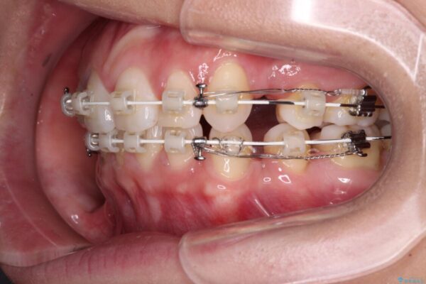 唇を閉じやすく　出っ歯の抜歯矯正 治療途中画像