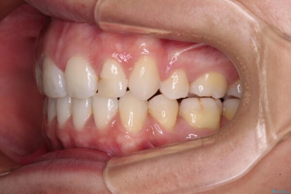 唇を閉じやすく　出っ歯の抜歯矯正 治療後画像