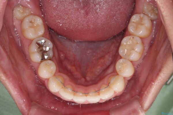 唇を閉じやすく　出っ歯の抜歯矯正 治療後画像
