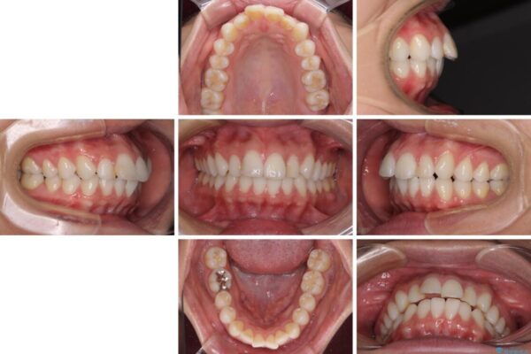 唇を閉じやすく　出っ歯の抜歯矯正 治療前画像