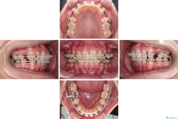 唇を閉じやすく　出っ歯の抜歯矯正 治療途中画像