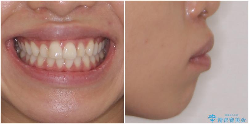 唇を閉じやすく　出っ歯の抜歯矯正 治療前
