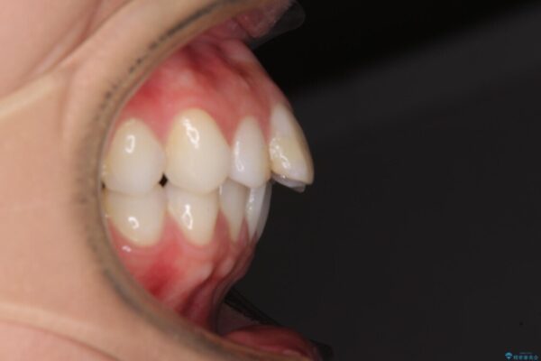 唇を閉じやすく　出っ歯の抜歯矯正 治療前画像