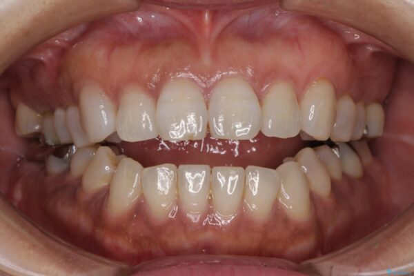 極端な上下前歯の開咬を改善　オープンバイトのインビザライン矯正 治療前画像