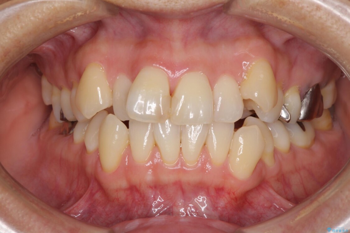 八重歯で口元が膨れている　ワイヤー装置での抜歯矯正 治療前