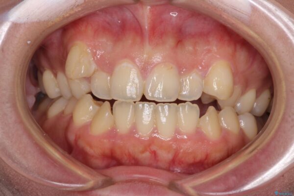 八重歯を抜歯矯正でスッキリと　メタルブラケットでの矯正治療 ビフォー