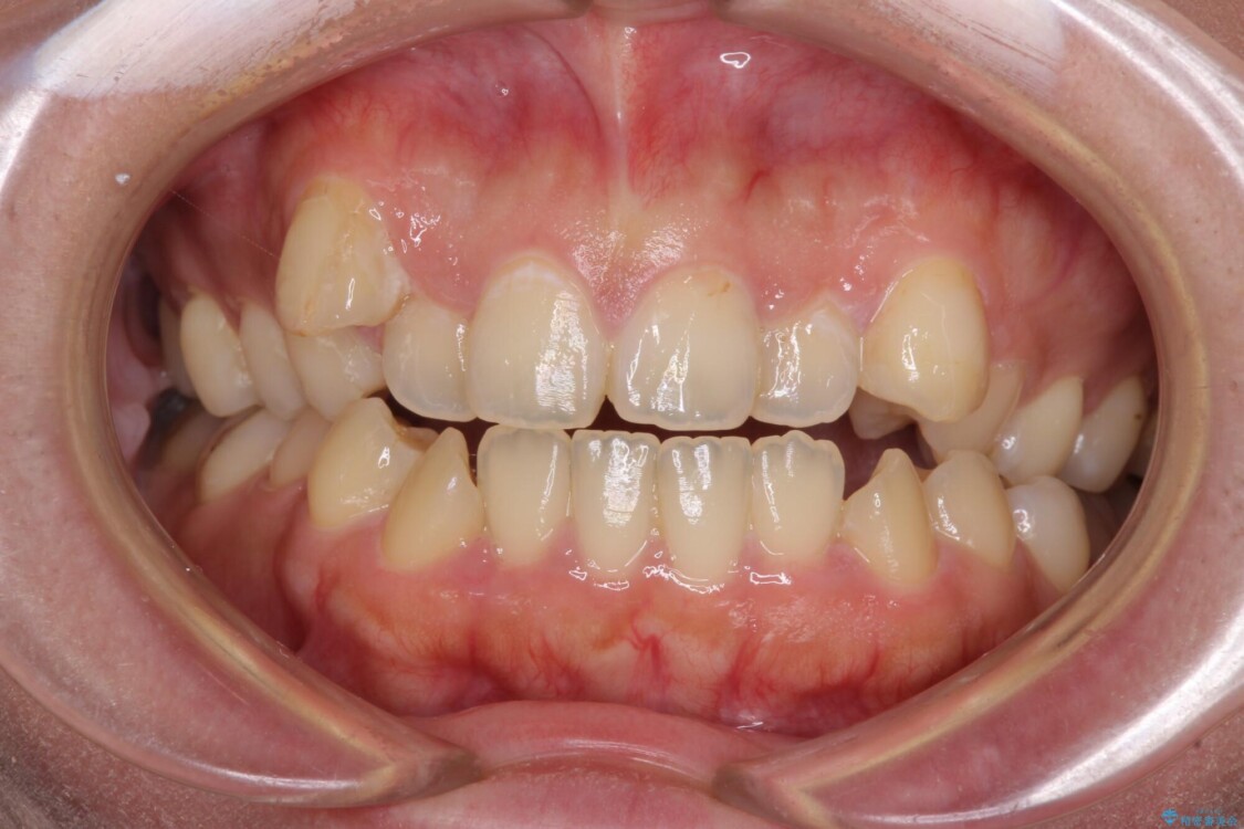 八重歯を抜歯矯正でスッキリと　メタルブラケットでの矯正治療 治療前