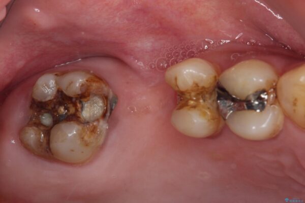放置した奥歯の虫歯　セラミックブリッジによる補綴治療 治療前画像