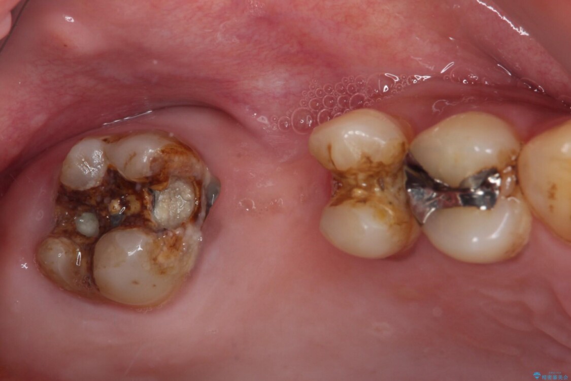 放置した奥歯の虫歯　セラミックブリッジによる補綴治療 治療前