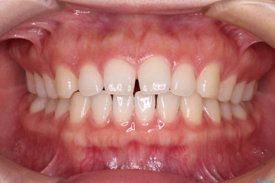 すきっ歯とオープンバイト　インビザライン・ライトで改善 治療前