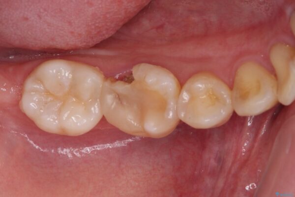 歯が欠けてしみる　オールセラミッククラウンによる虫歯治療 治療前画像