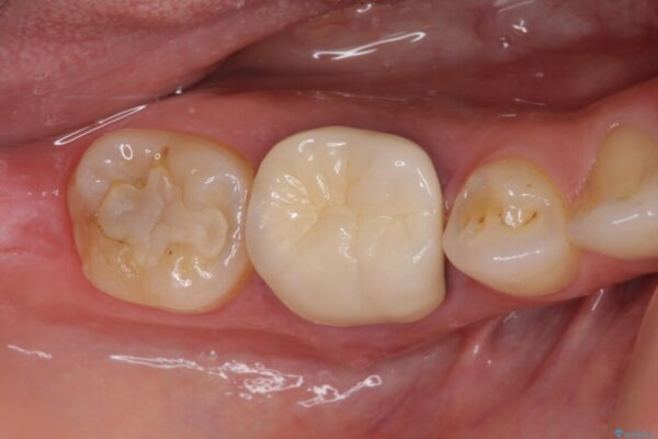 奥歯の歯茎から膿が出る　根管治療とオールセラミッククラウン ビフォー