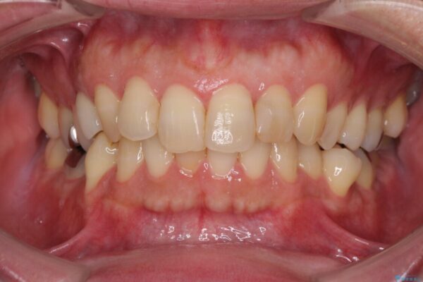外側に飛び出した歯　インビザラインによる矯正治療 治療前画像