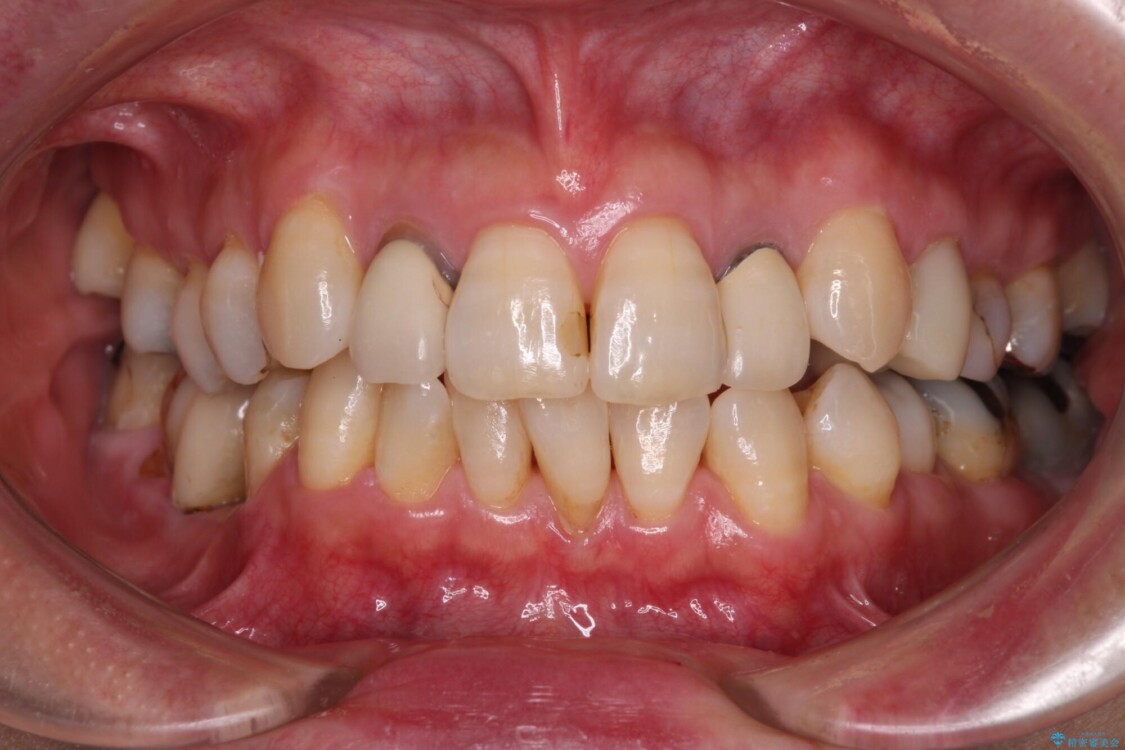歯根が見えてしみる　歯肉移植による歯肉退縮の改善 治療前