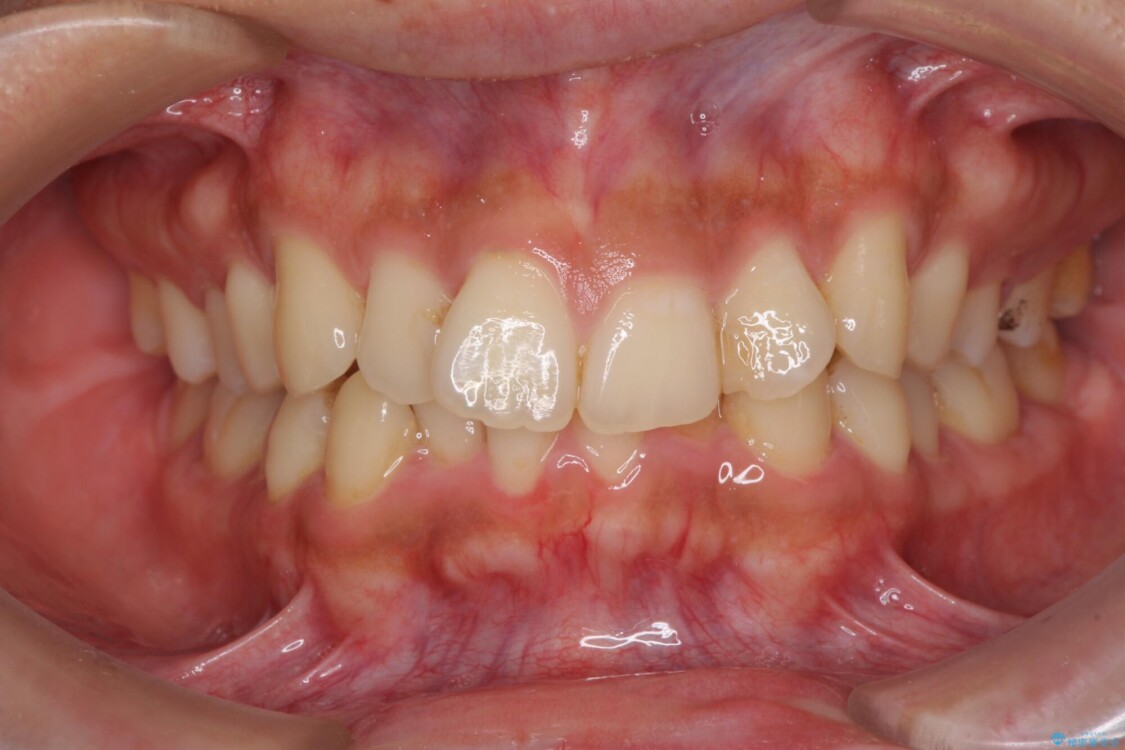 前歯のデコボコをスッキリ改善　インビザライン矯正 治療前