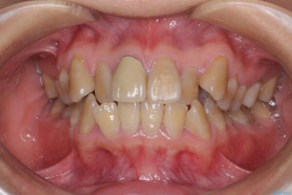 八重歯とクロスバイト　目立たないワイヤー装置での抜歯矯正 治療前画像