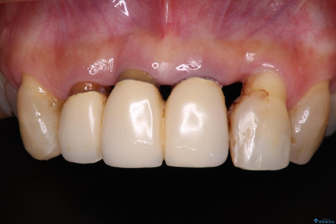 不具合ばかりの前歯　前歯のオールセラミックブリッジ 治療前