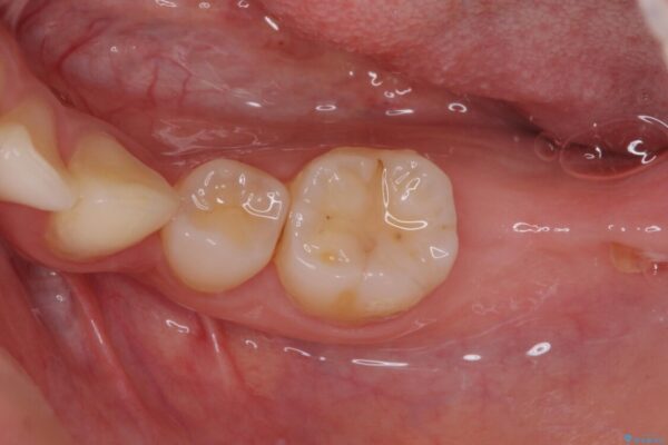 部分矯正を併用した奥歯のインプラント治療 ビフォー