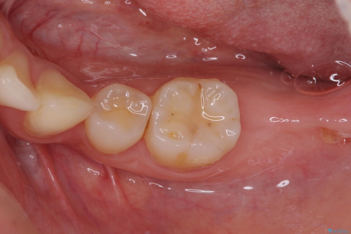 部分矯正を併用した奥歯のインプラント治療 治療前