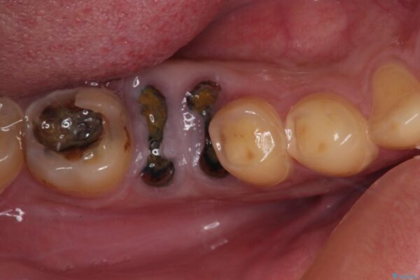 放置した虫歯　奥歯のオールセラミックブリッジ治療 ビフォー