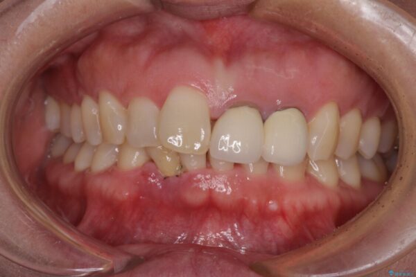 前歯のインプラント治療　折角なので矯正治療できれいな歯並びに ビフォー