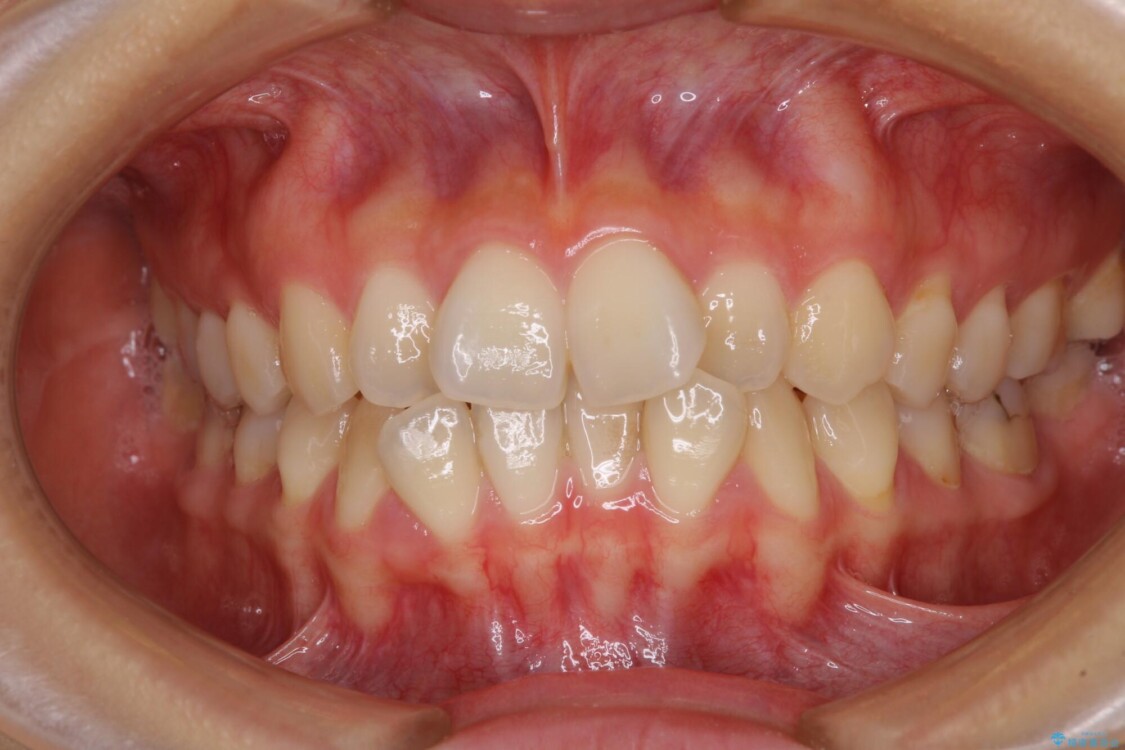 前歯のクロスバイト　ワイヤー装置を併用したインビザライン矯正 治療前