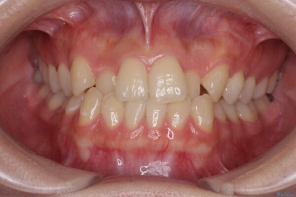 前歯のクロスバイトを短期間で解消　目立たないワイヤー矯正 ビフォー