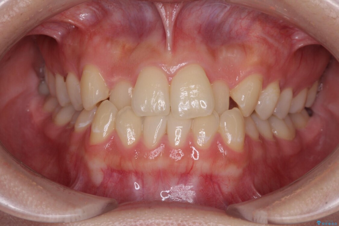 前歯のクロスバイトを短期間で解消　目立たないワイヤー矯正 治療前