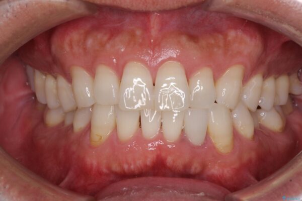 内側にある歯が干渉する　上顎前歯の部分矯正 ビフォー