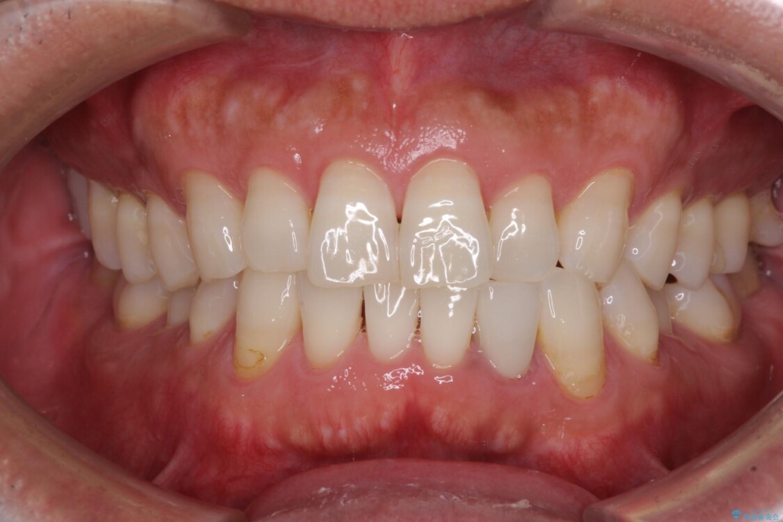 内側にある歯が干渉する　上顎前歯の部分矯正 治療前