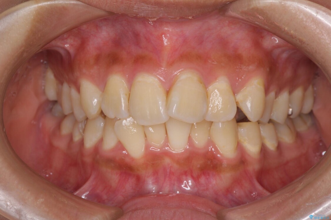 デコボコで磨きにくい前歯をスッキリと　インビザライン矯正 治療前